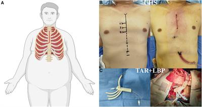 Obesity and acute type A aortic dissection: unraveling surgical outcomes through the lens of the upper hemisternotomy approach